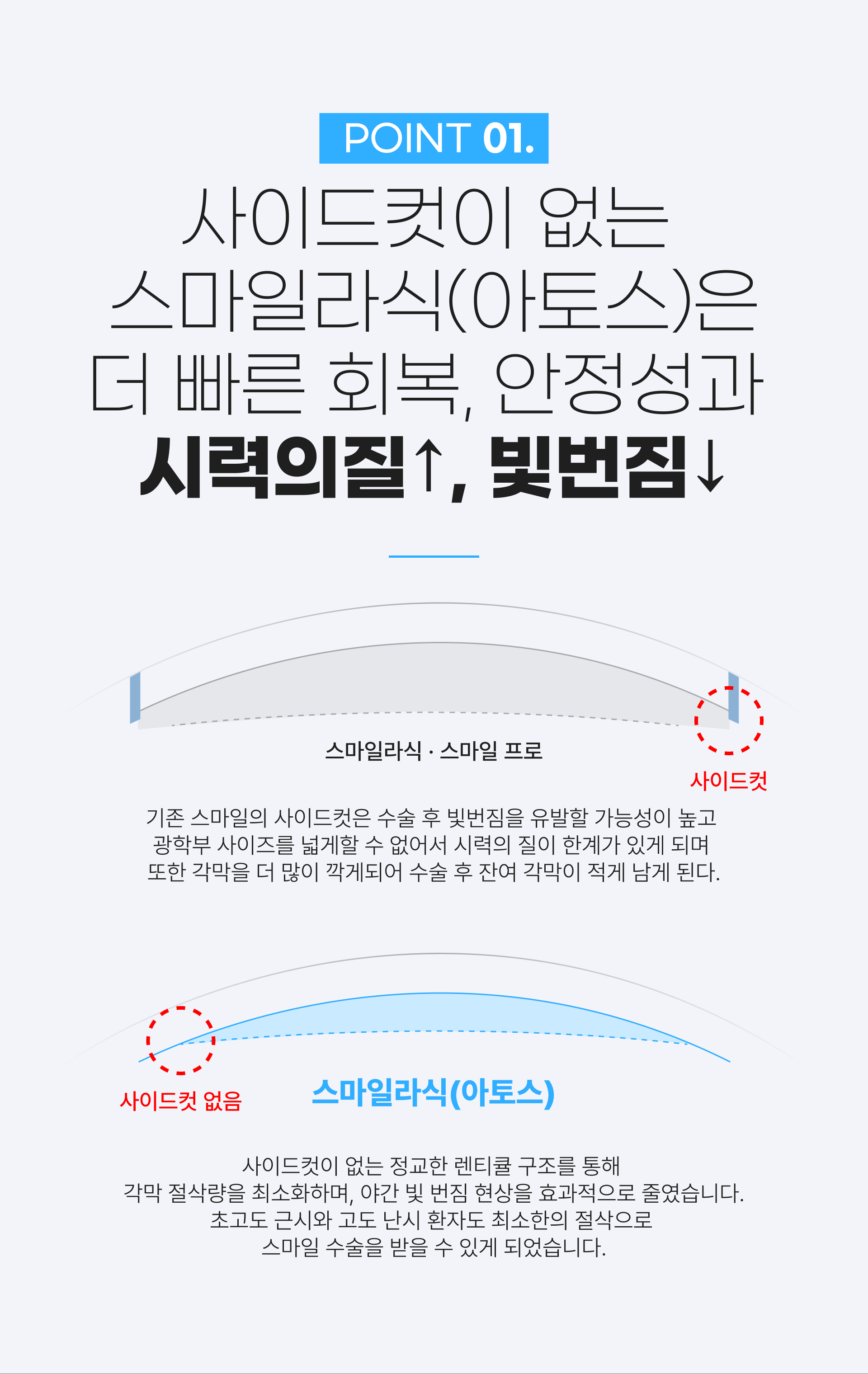 스마트 스마일 라식 특징 1