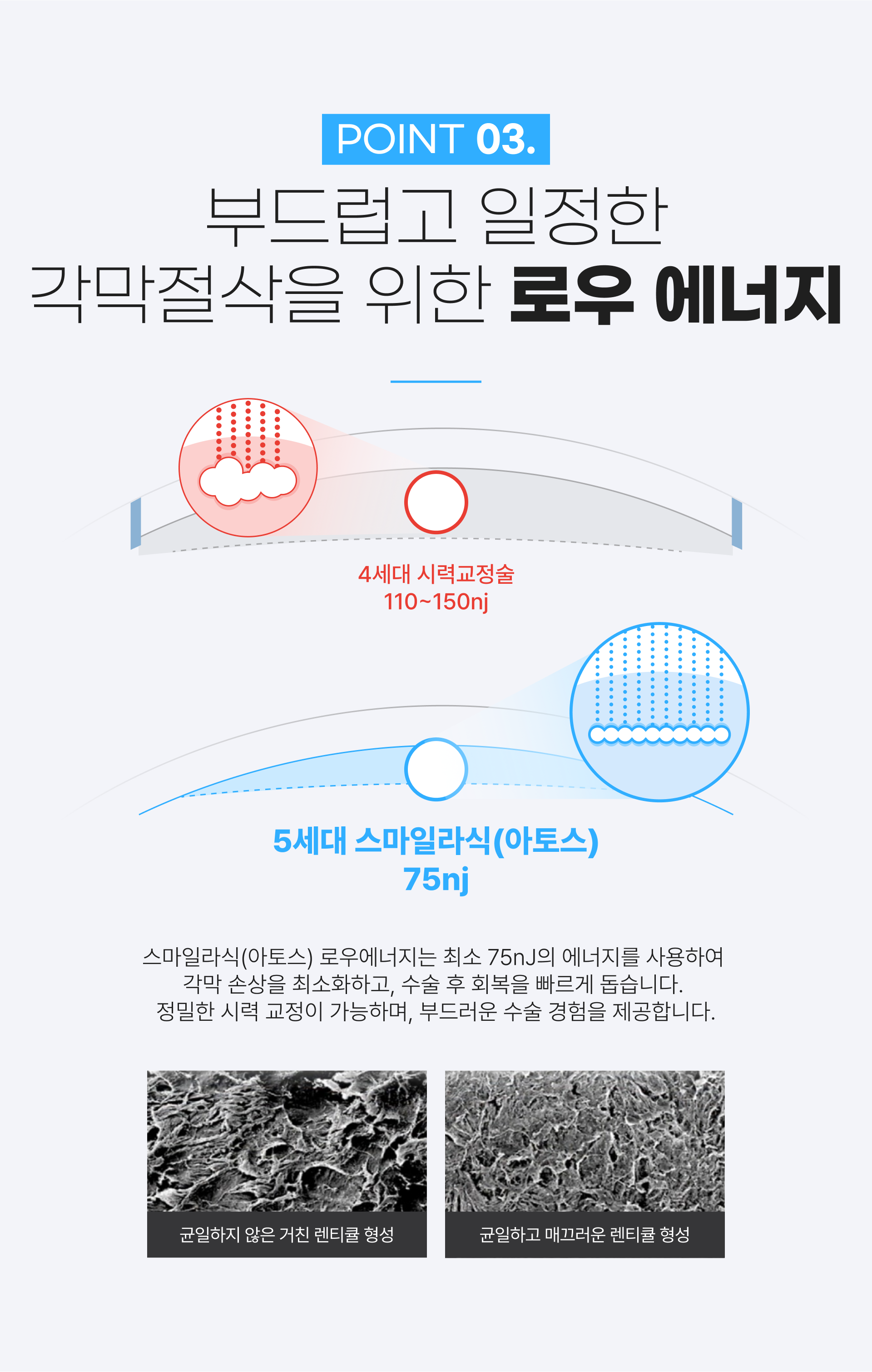 스마트 스마일 라식 특징 3